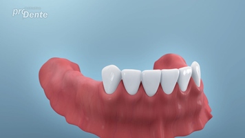 Quelle Initiative proDente Zahnimplantate Zahnersatz für verlorene Backenzähne