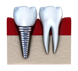 Neuartige Zahnimplantate: Kurzimplantate | Zahnarzt Dr. Oberg, Rellingen